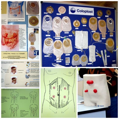 калоприемники, стома, стомированные люди